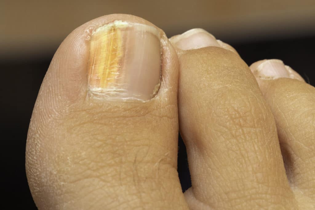 Laser Treatment for Toenail Fungus Family Foot Care & Surgery