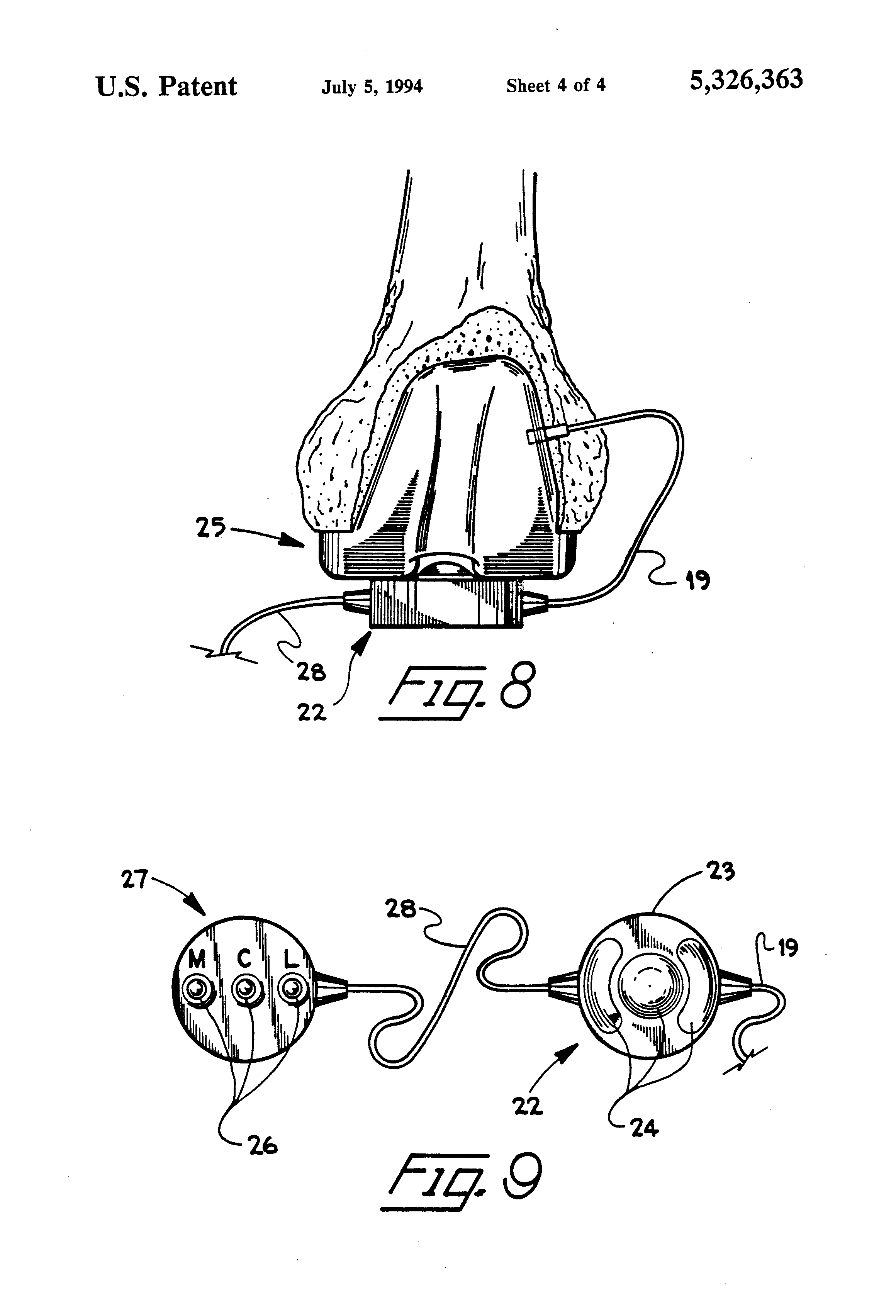 Patent US5326363 Provisional implant Google Patents