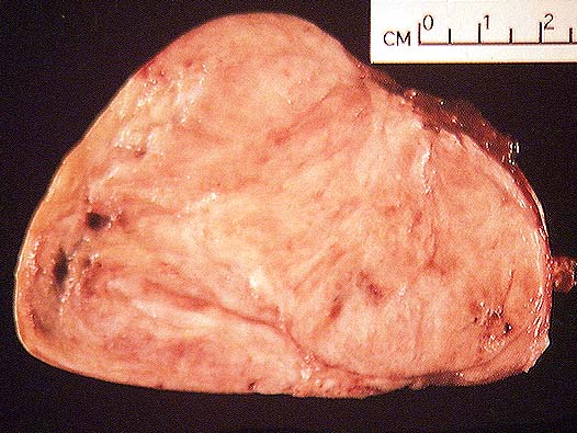 Malignant Encapsulated Malignant Tumors