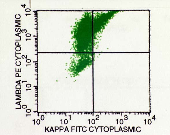 Lambda Light Chain Multiple Myeloma Icd 10