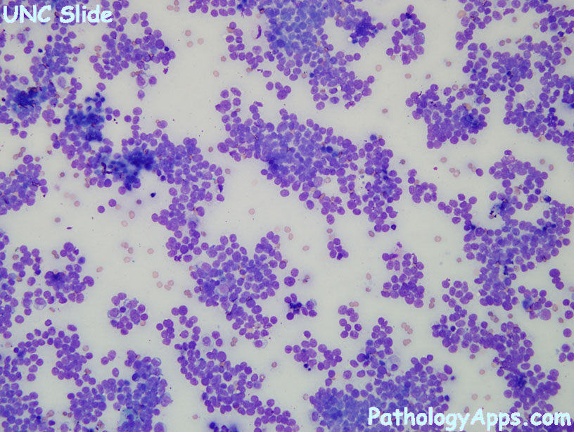 ewing soft tissue cytology