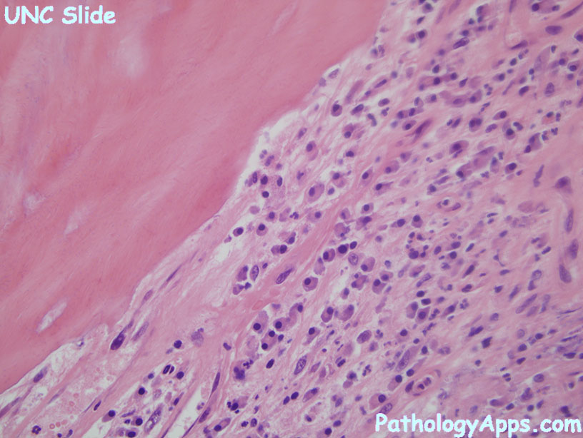 chronic osteomyelitis bone histology