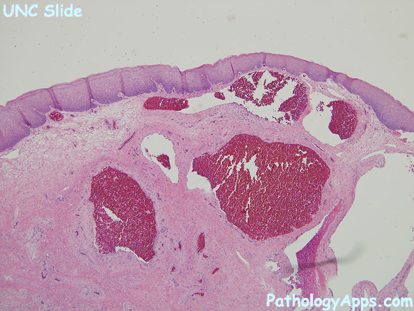 Thrombosed Hemorrhoid Histology