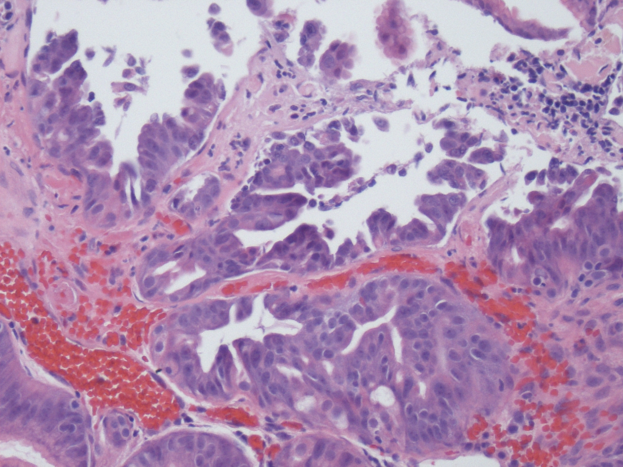 Pathology Outlines Fundic gland polyp