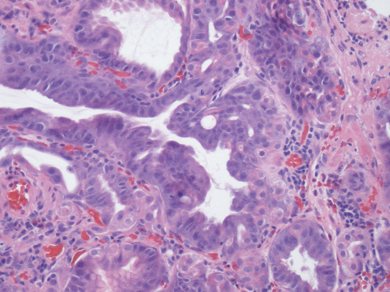 Pathology Outlines Fundic gland polyp