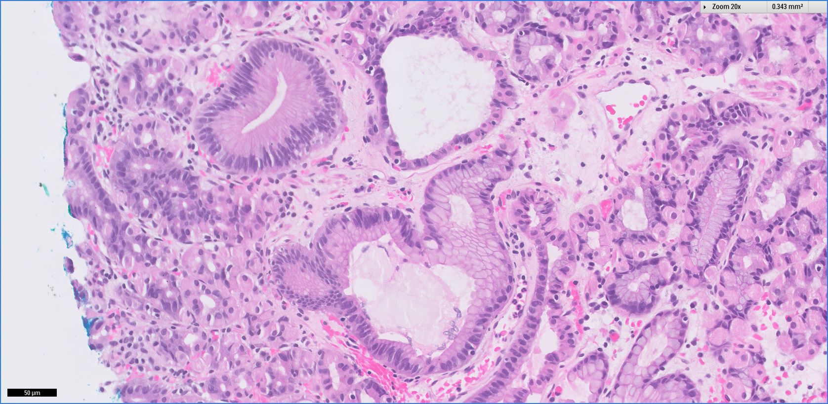 Pathology Outlines Fundic gland polyp