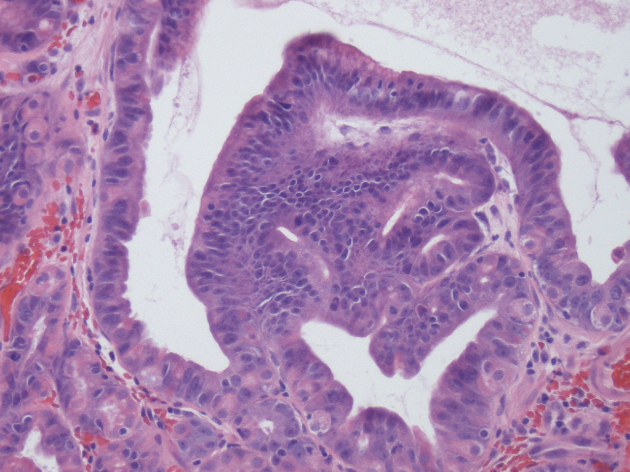 Pathology Outlines Fundic gland polyp