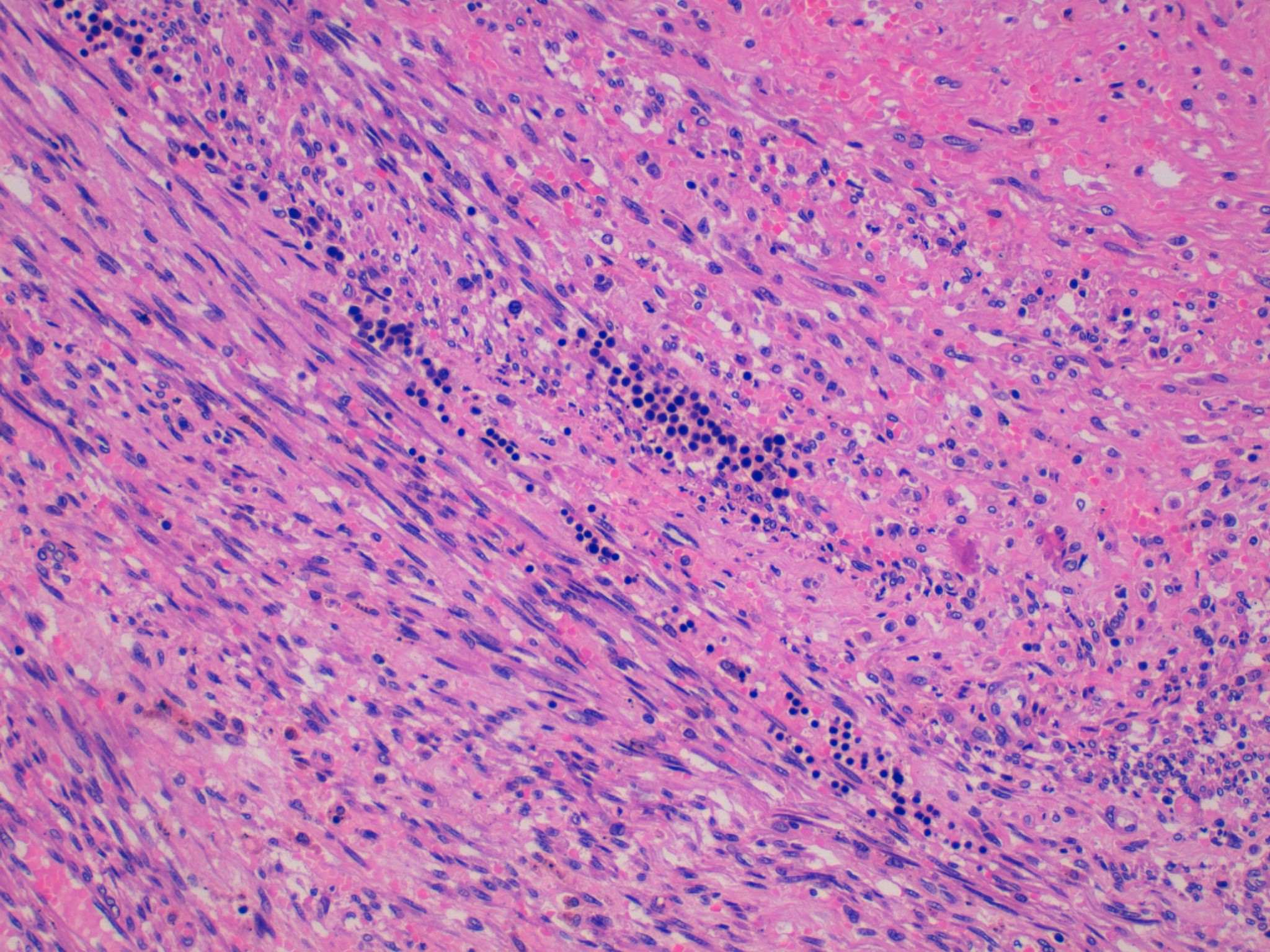 Pathology Outlines Leiomyoma