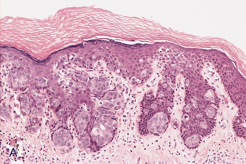 Pathology Outlines Extramammary Paget disease