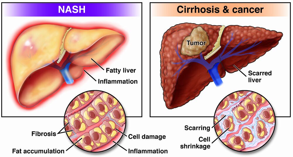 Nonalcoholic fatty liver disease (NAFLD) and nonalcoholic