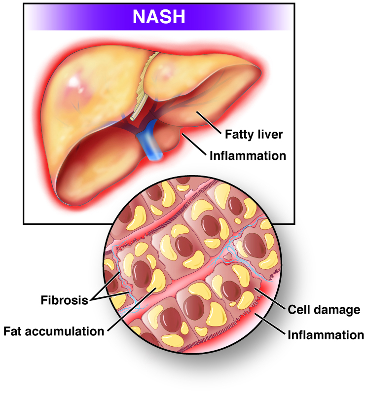 Nonalcoholic fatty liver disease (NAFLD) and nonalcoholic