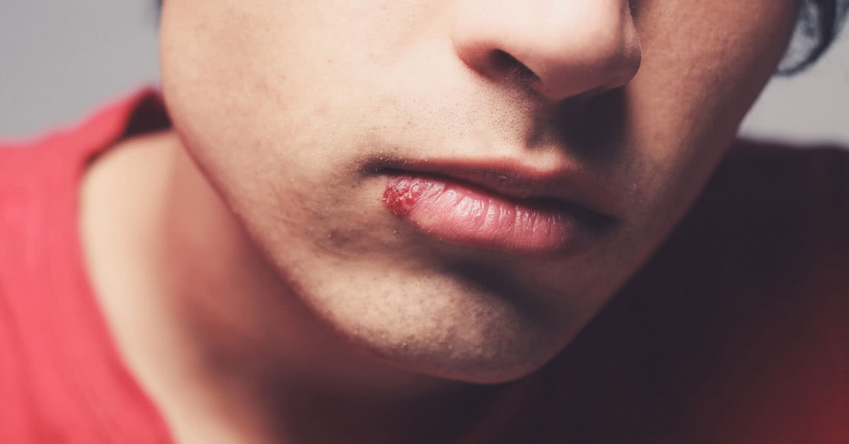 Cold Sore Treatment Online Amwell for Patients