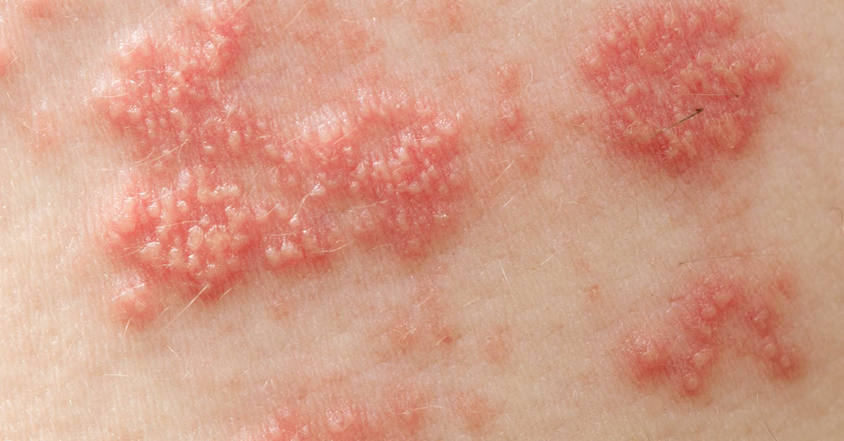 Shingles Treatment Online Amwell for Patients