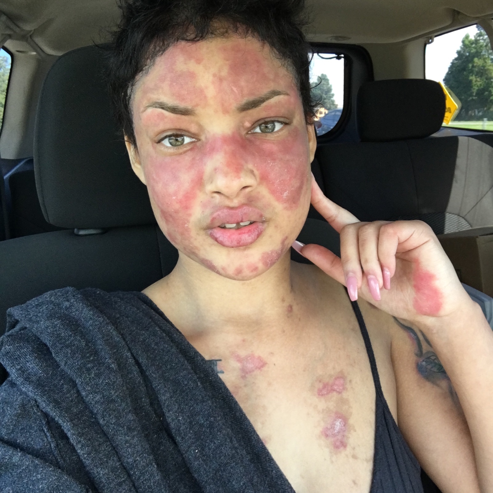 Lupus advocate Jokiva Bellard raises awareness on Instagram