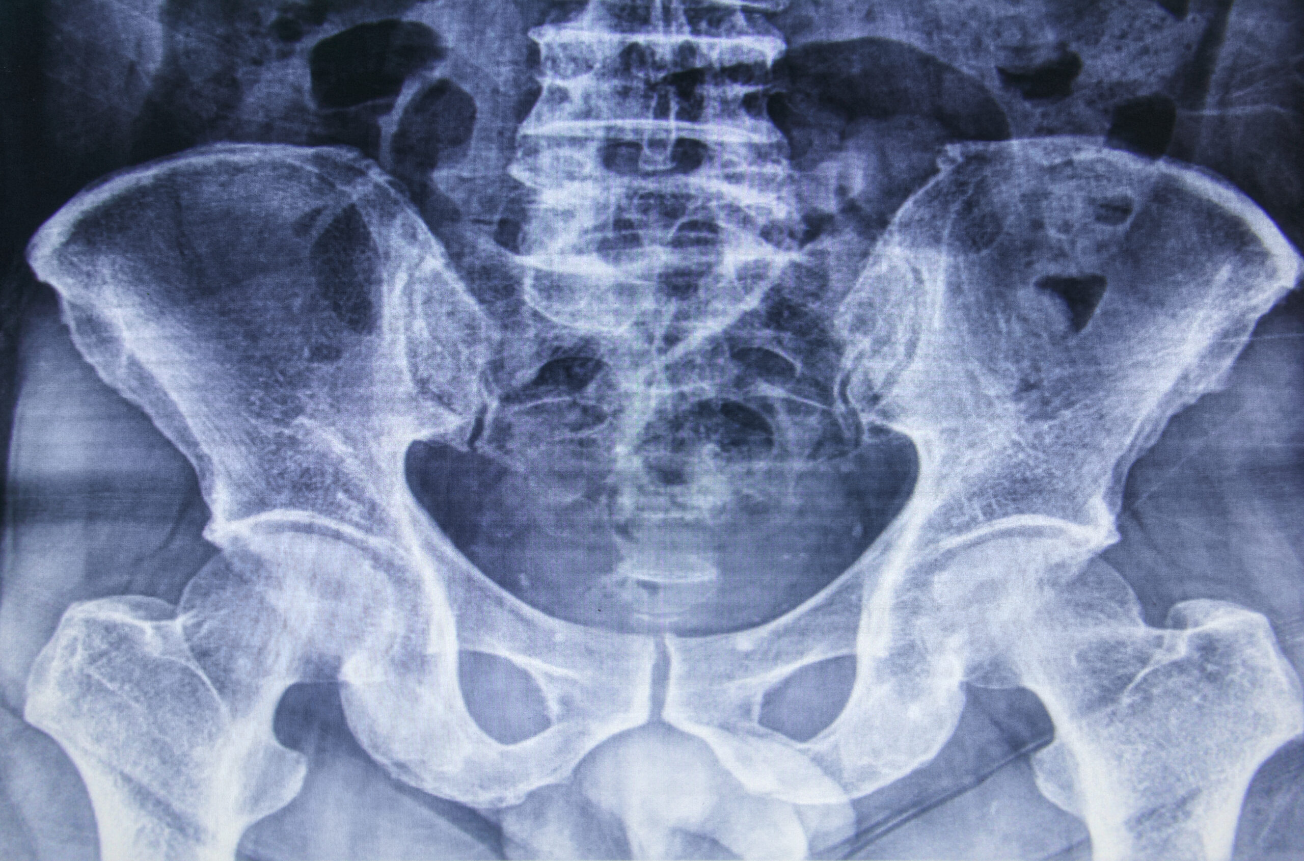 Are there any alternatives to hip replacement surgery? Paul Jairaj