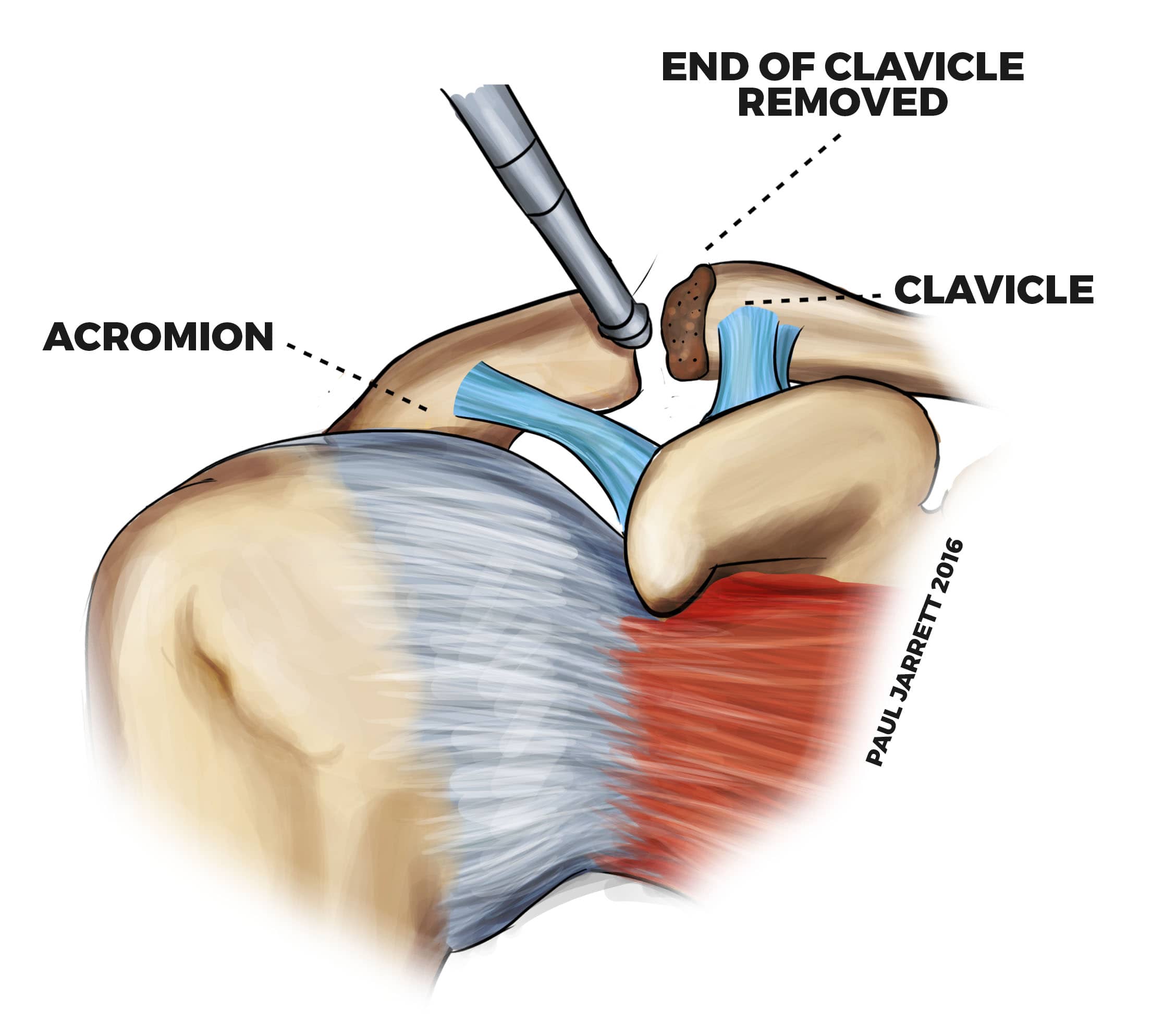 Acromioclavicular Joint Arthritis Dr Paul Jarrett. Orthopaedic Surgeon Perth