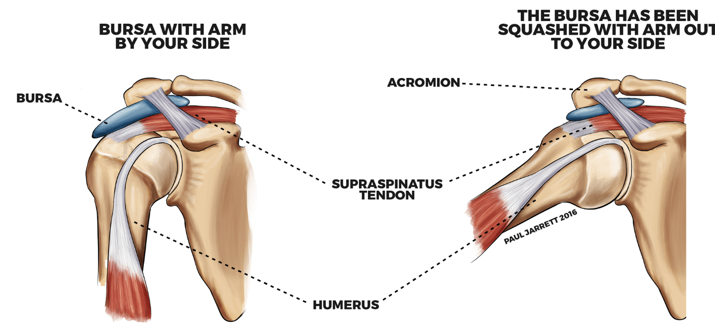 Impingement & Bursitis Dr Paul Jarrett, Orthopaedic Surgeon Perth