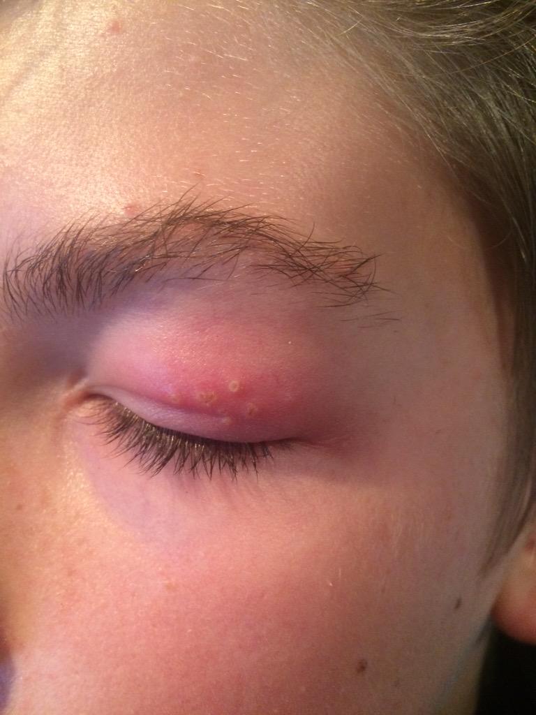 Mrs BFNA 🐝 on Twitter "Baby BFNA has shingles in his eye lid. Poor