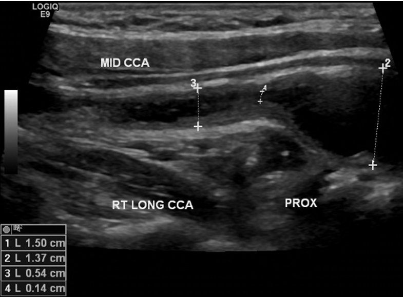 Ido Weinberg, MD on Twitter "How Takayasu's Arteritis carotid 