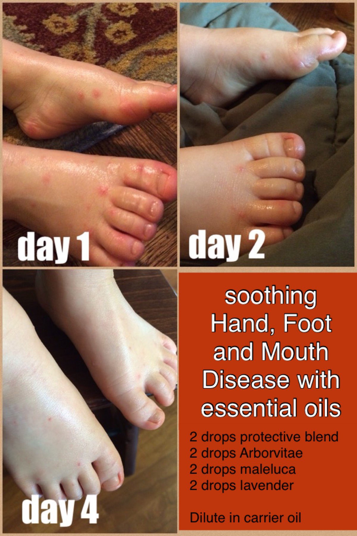 How To Cure Foot And Mouth Disease Dreamopportunity25