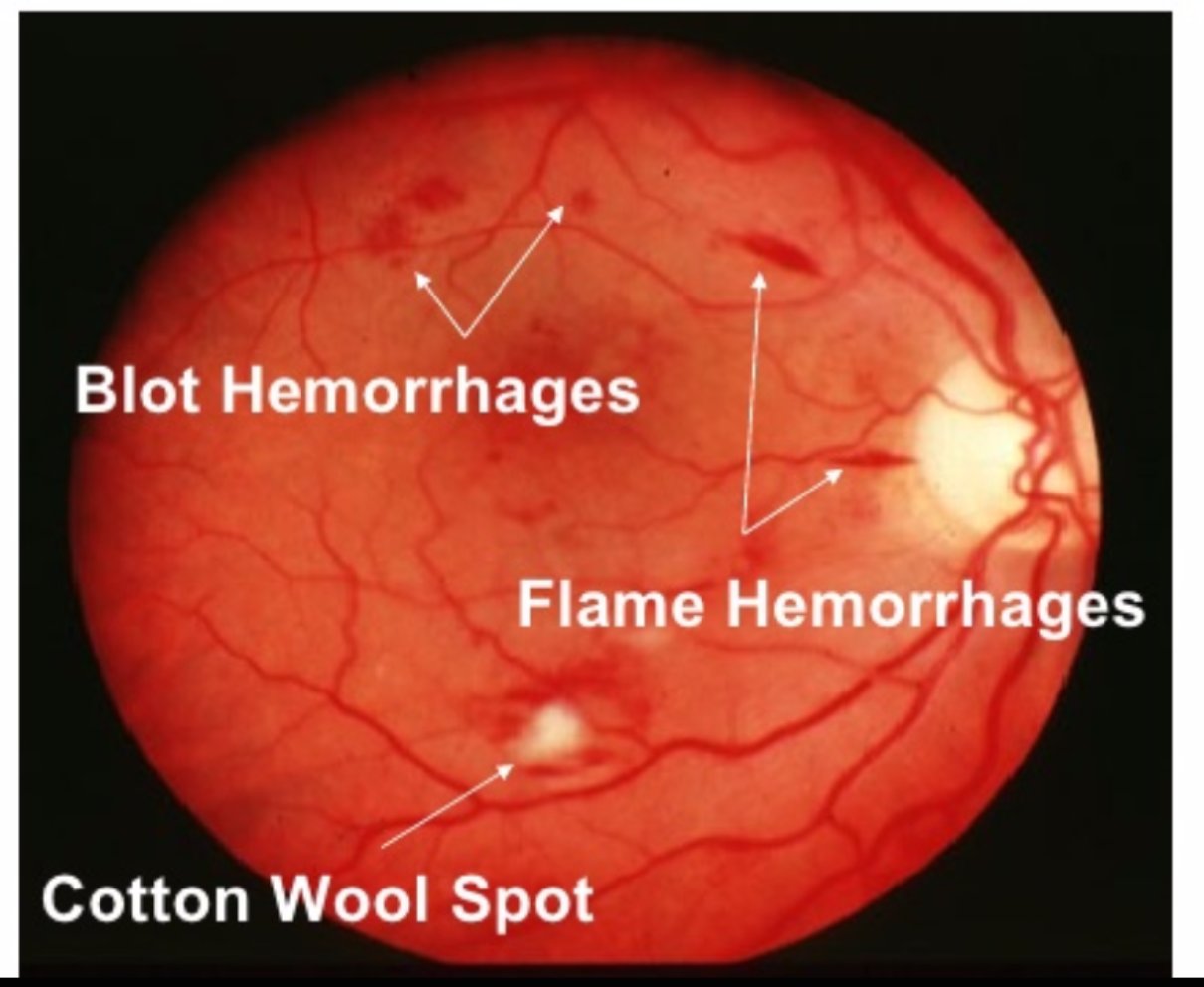 Eye Atlas on Twitter "Fundus findings in Diabetic Retinopathy Blot