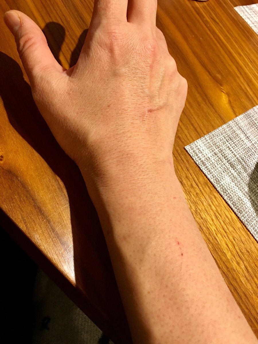 [最新] 腕 血管 浮き出る なぜ 906849腕 血管 浮き出る なぜ Bestpixtajpkanb