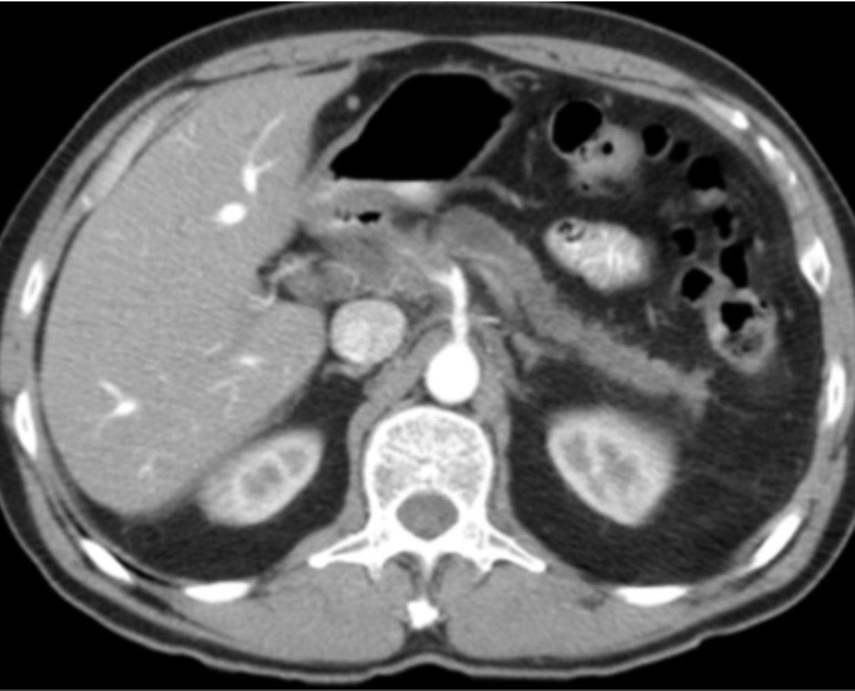 How Often Is Pancreatic Cancer Missed On Ct Scan ct scan