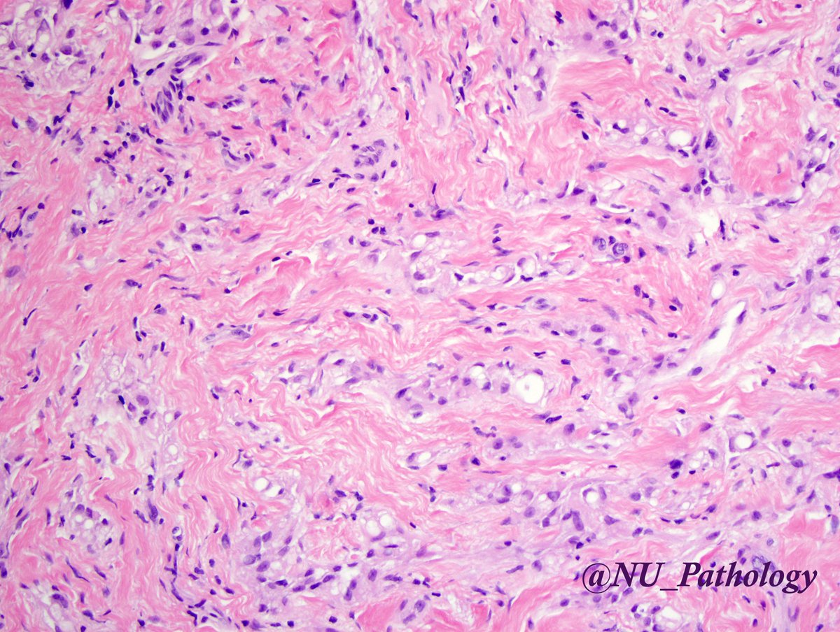 Malignant Spindle Cell Tumor Pathology Outlines