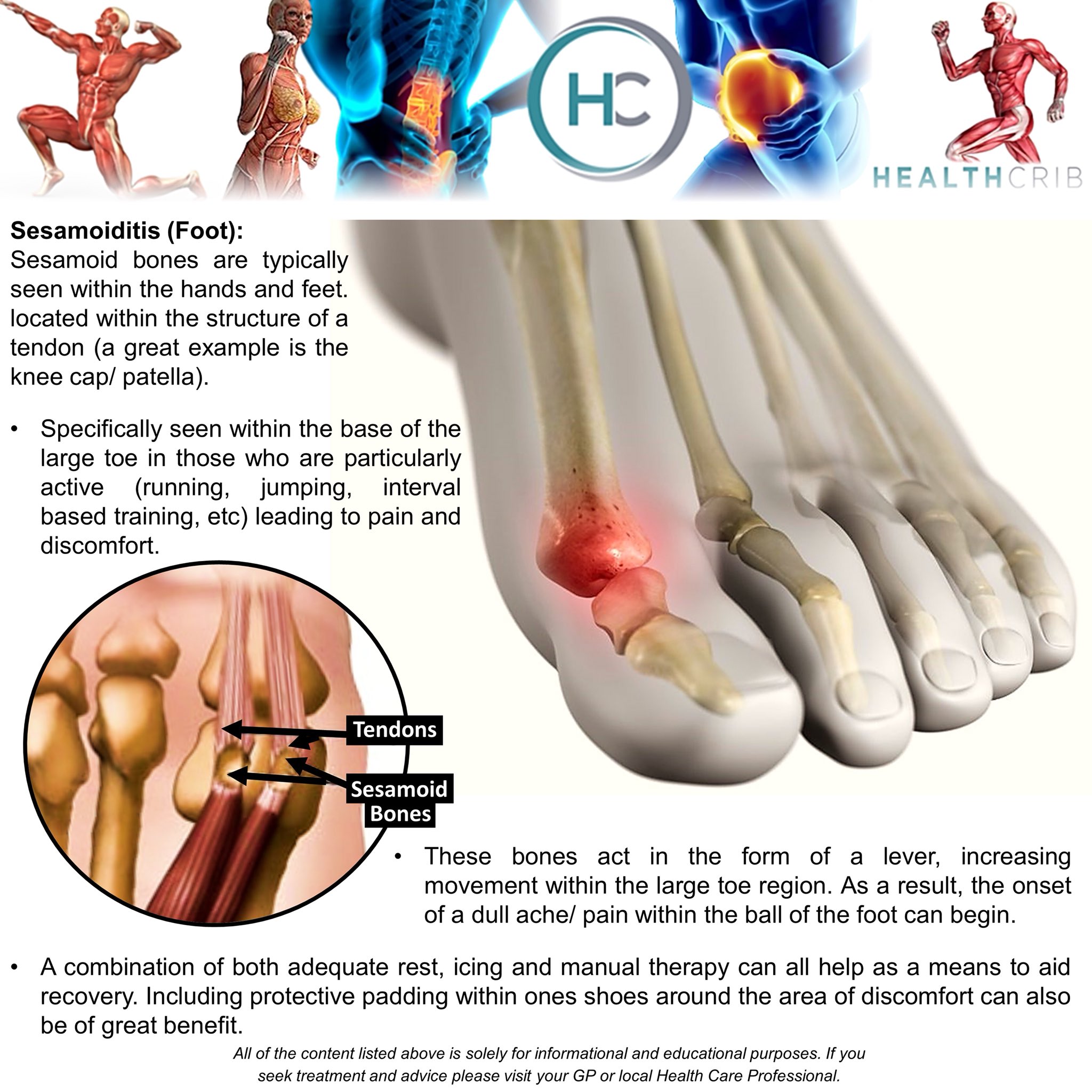 HealthCrib on Twitter "THE FOOT Sesamoiditis of the foot (big toe
