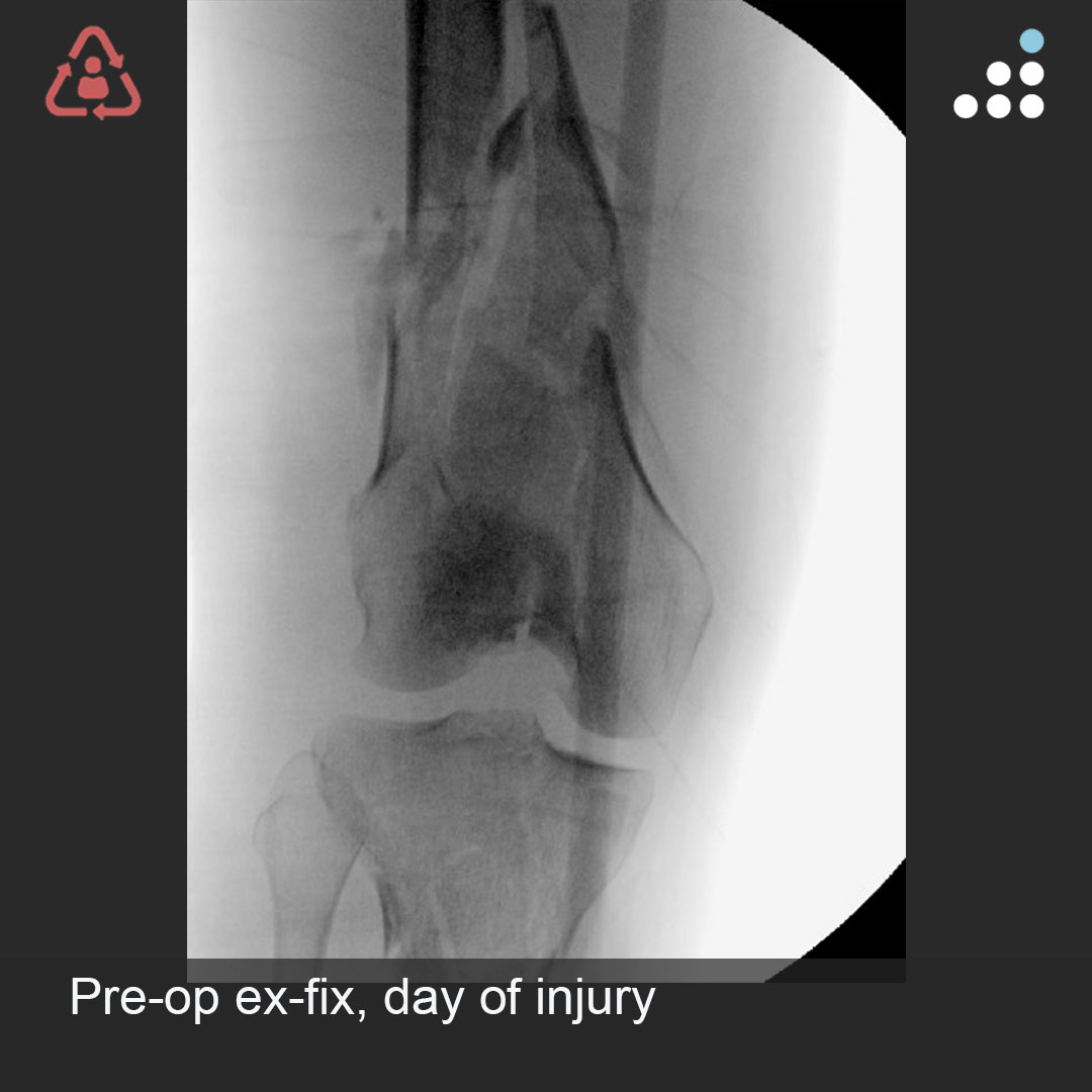 Orthobullets on Twitter "Here are intraop & postop images of yesterday's case by Dr. Michael