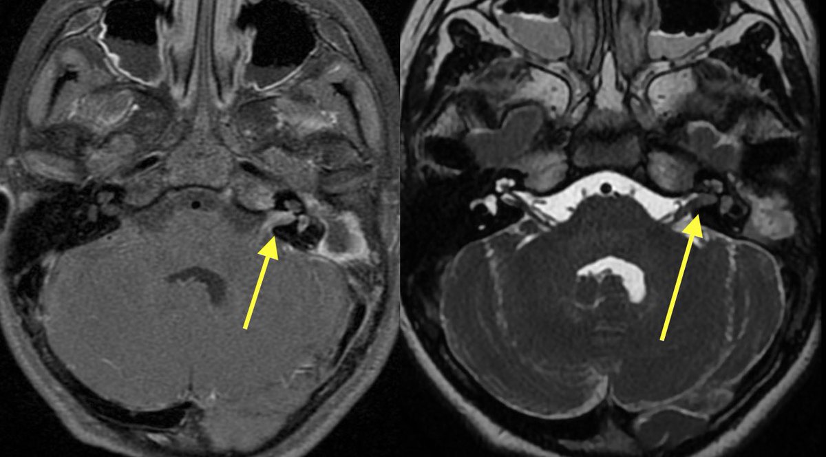 Complicated case in this patient with ear pain, fever, and headache 