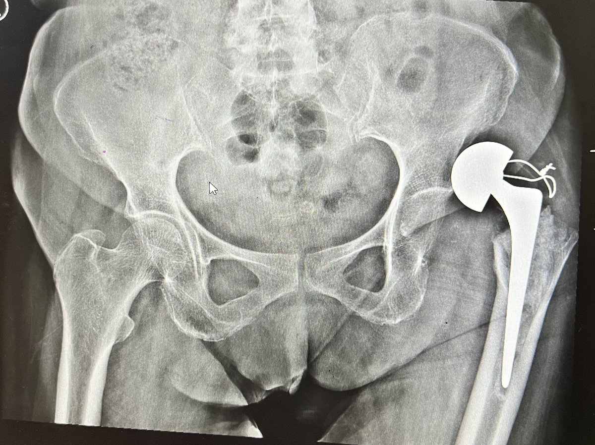 Bipin Theruvil FRCS Orth, FRCS (Ed&Glasg),MS AIIMS on Twitter "Frail