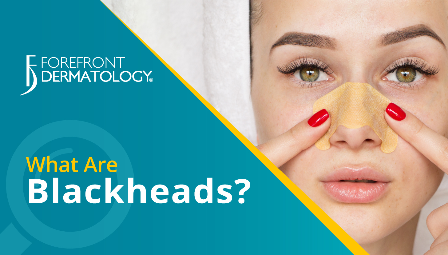 What are Blackheads? Premier Dermatology