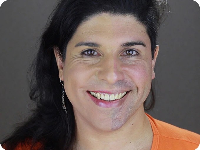 Permanent hair removal for transgender women Peach Clinics