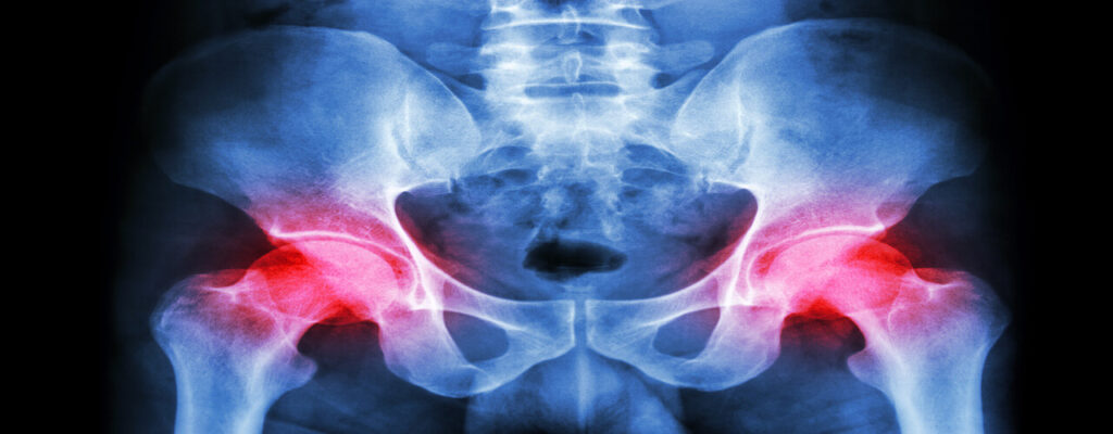 Symphysis Pubis Dysfunction Peach Physiotherapy