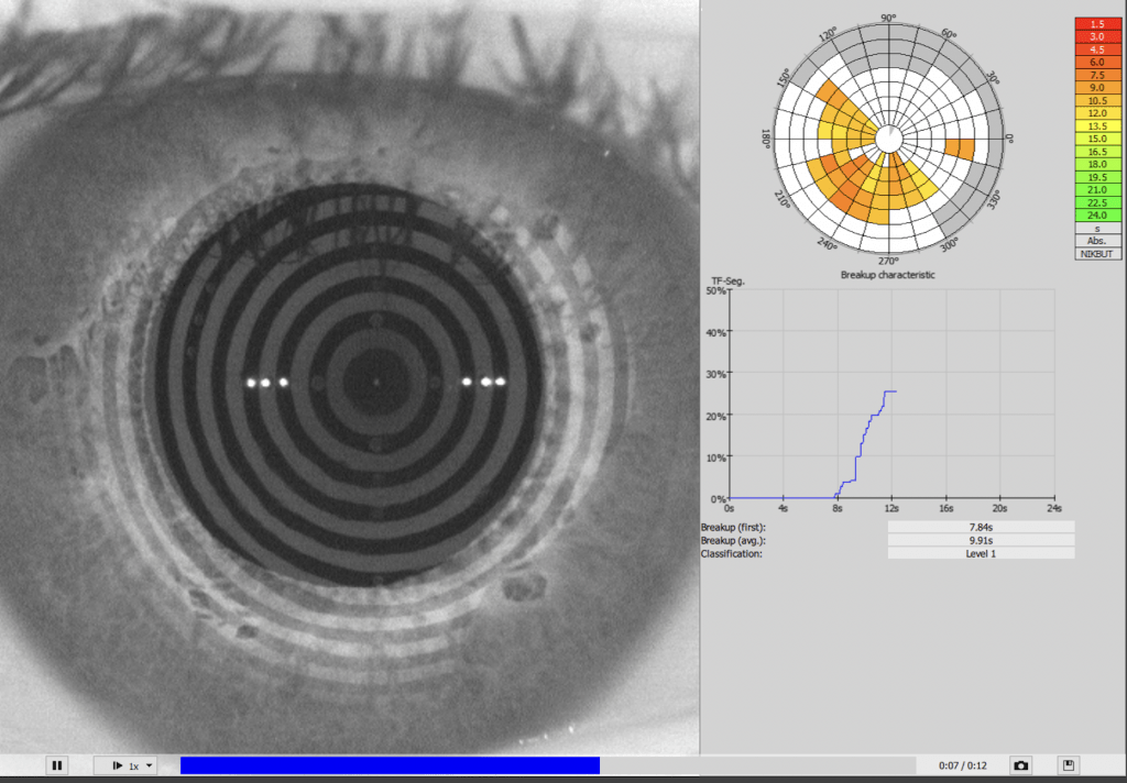 Evaporative Dry Eye (Part 2) Peak Eyecare