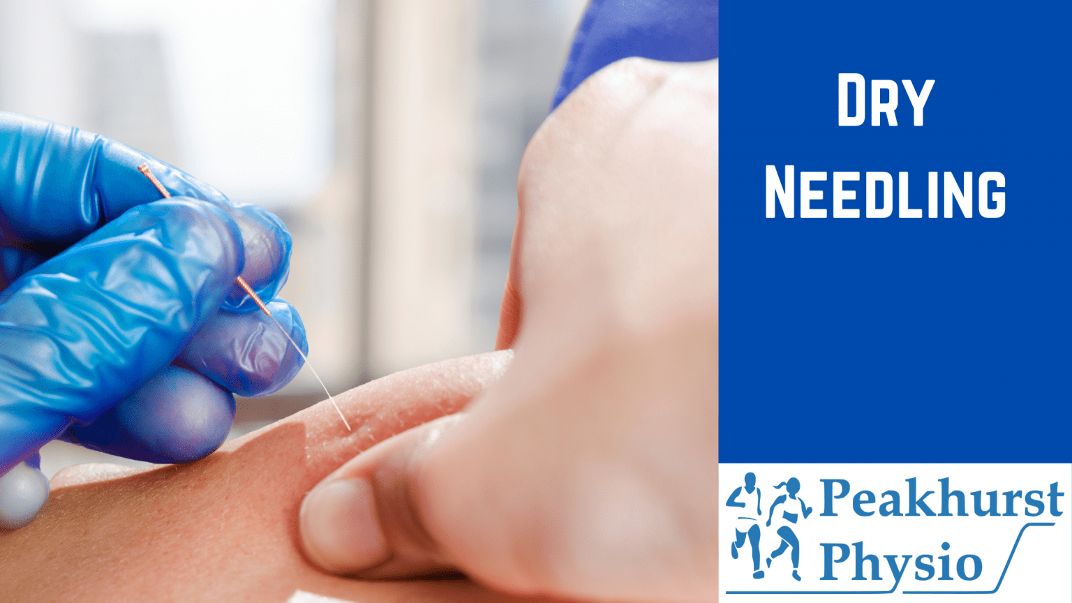 WHAT IS DRY NEEDLING? Peakhurst Physio