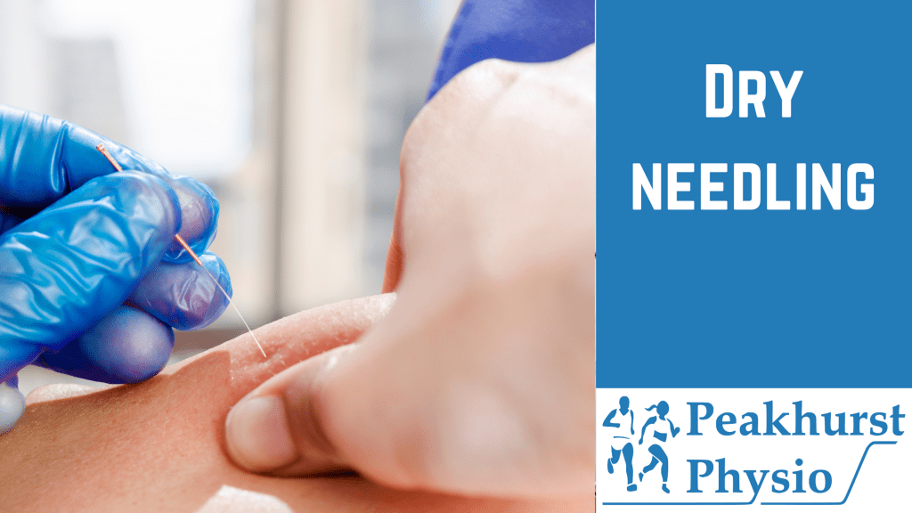 WHAT IS DRY NEEDLING? Peakhurst Physio