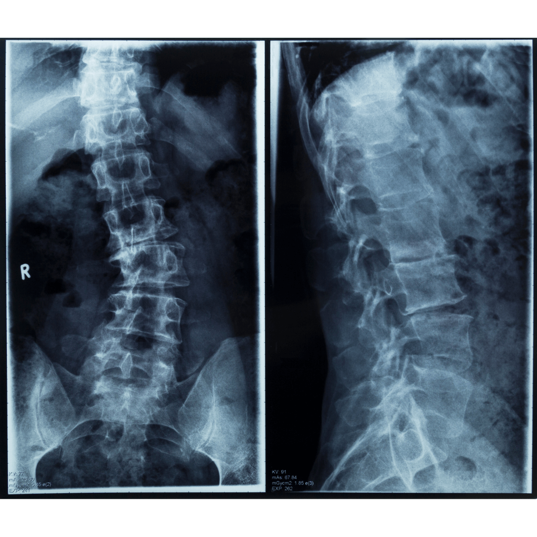 Scoliosis And Poor Posture PEAKiropractic