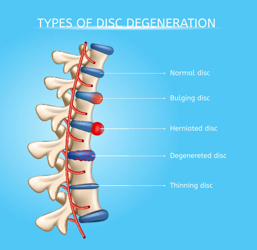 Herniated Discs Can Be a Real Pain in the Back Are You Living with One? Herniated Discs Can Be a Real Pain in the Back Are You Living with One?
