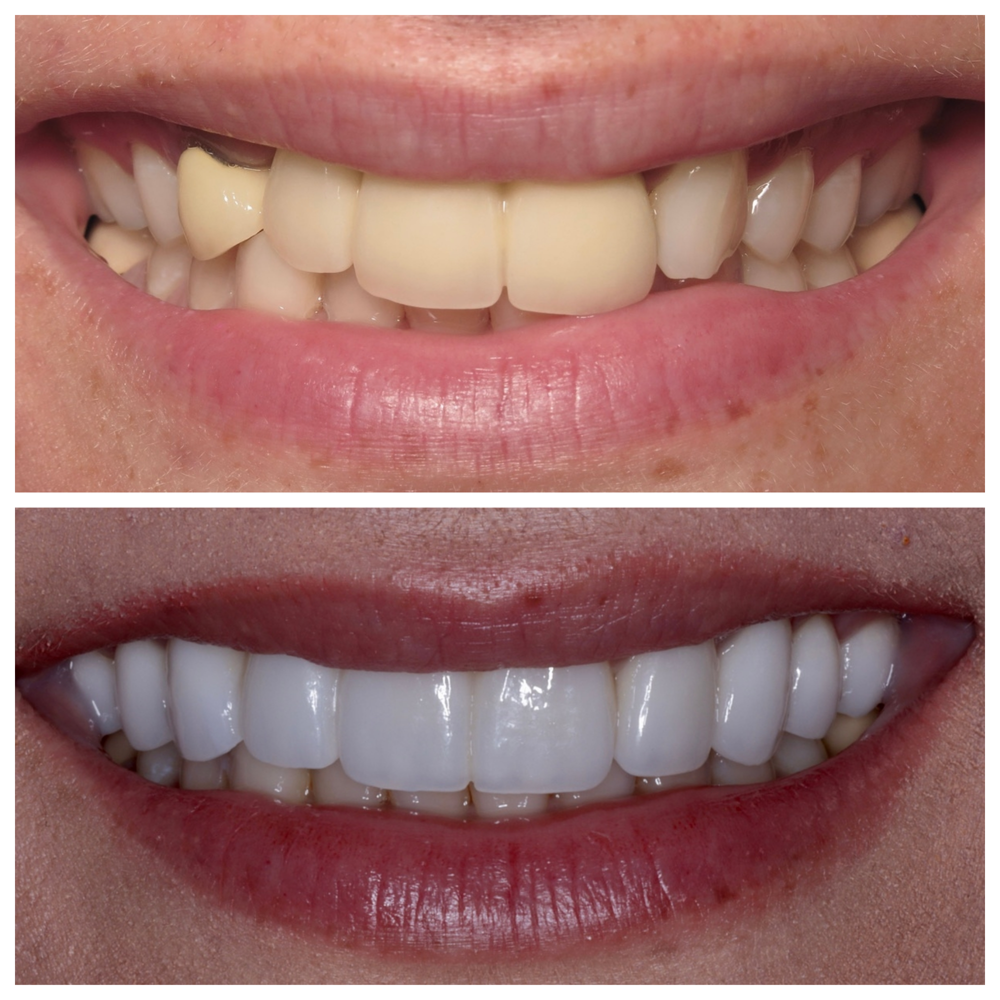 Veneers Charlotte NC Charlotte Veneers Porcelain Pearl