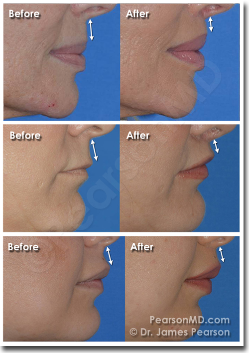 Lip Lift Dr. James Pearson Facial Plastic Surgery