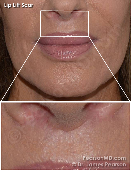 Lip Lift Dr. James Pearson Facial Plastic Surgery