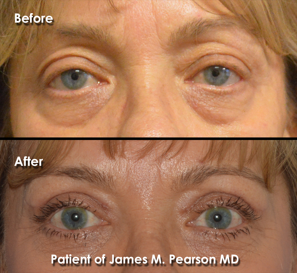 Before & After Photos, Photo Gallery Dr. James Pearson Facial Plastic
