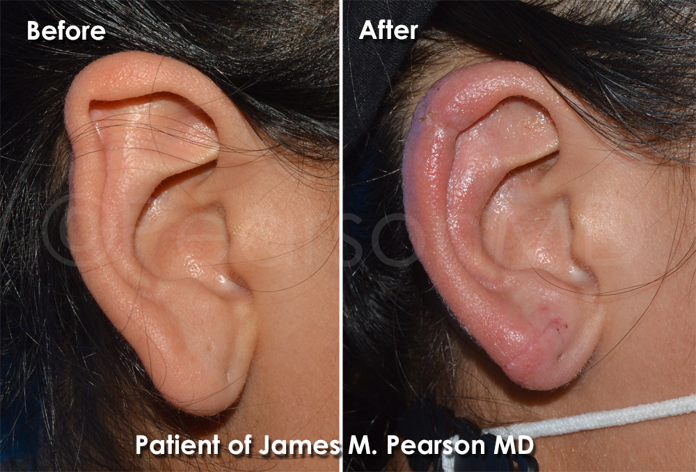 Ear Contouring Surgery Photos Dr. James Pearson Facial Plastic Surgery