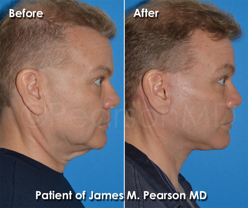 Facelift Photos Before & After Dr. James Pearson Facial Plastic Surgery