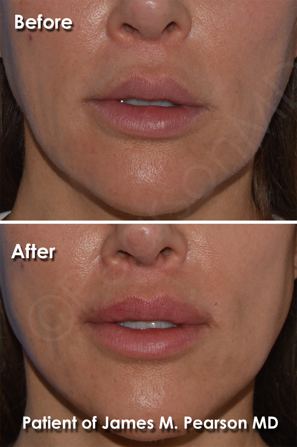 Lip Lift Photos Before & After Dr. James Pearson Facial Plastic Surgery