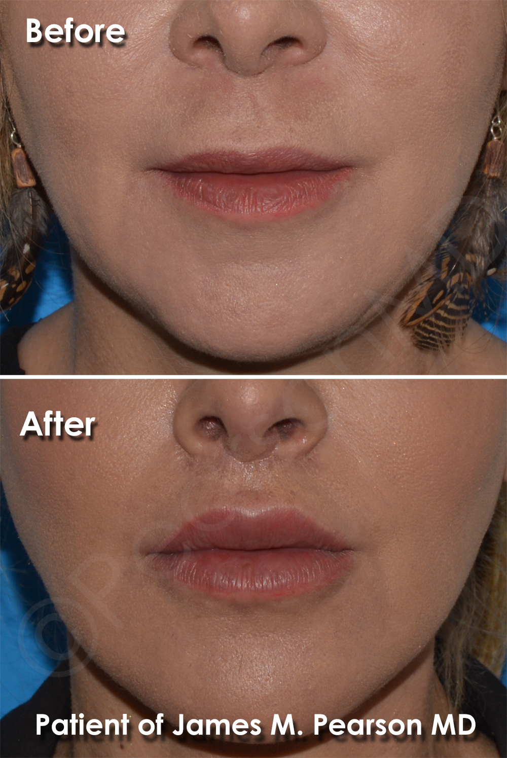 Lip Lift Photos Before & After Dr. James Pearson Facial Plastic Surgery