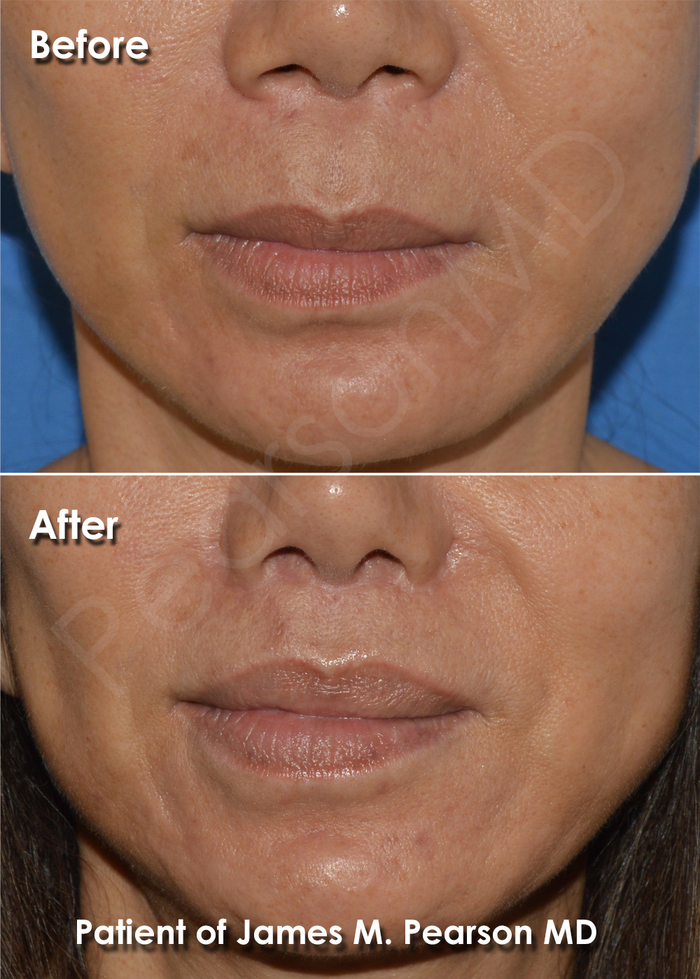 Lip Lift Photos Before & After Dr. James Pearson Facial Plastic Surgery