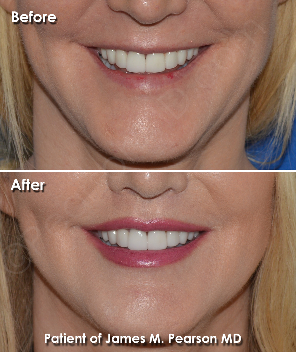 Lip Lift Photos Before & After Dr. James Pearson Facial Plastic Surgery